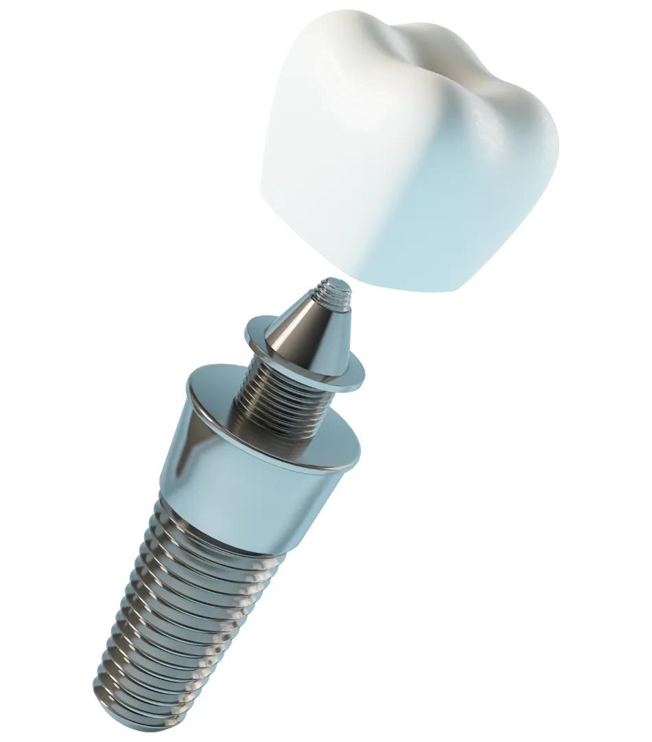 dental implant 3d